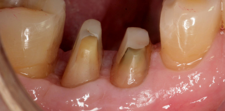 Parodontalchirurgie: Behandlungs­stufe 3 bei Parodontitis Stadium I–III