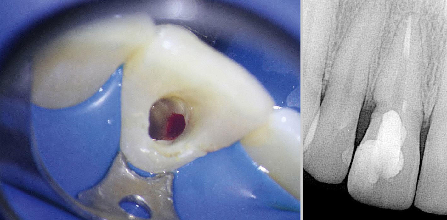 Nichtoperative Reparatur einer zervikalen Resorption