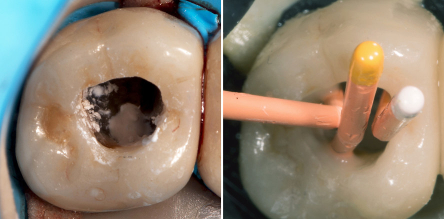 Optimale Restauration von Zähnen mit Perforationen