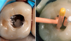 Optimale Restauration von Zähnen mit Perforationen