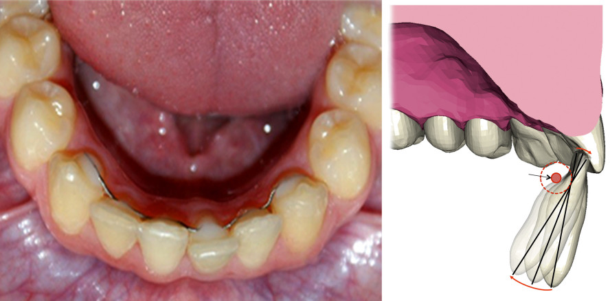 Der X-Effekt als unerwartete Komplikation nach Retainerklebung