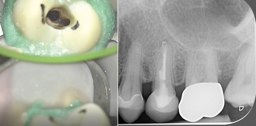 Orthograde Revision eines zweiten Oberkieferprämolaren