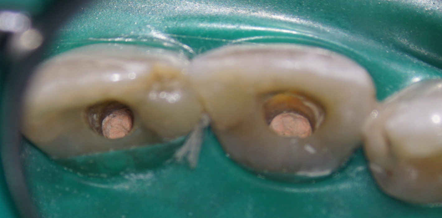 Ortho- und retrograde Revision zweier Oberkieferinzisivi