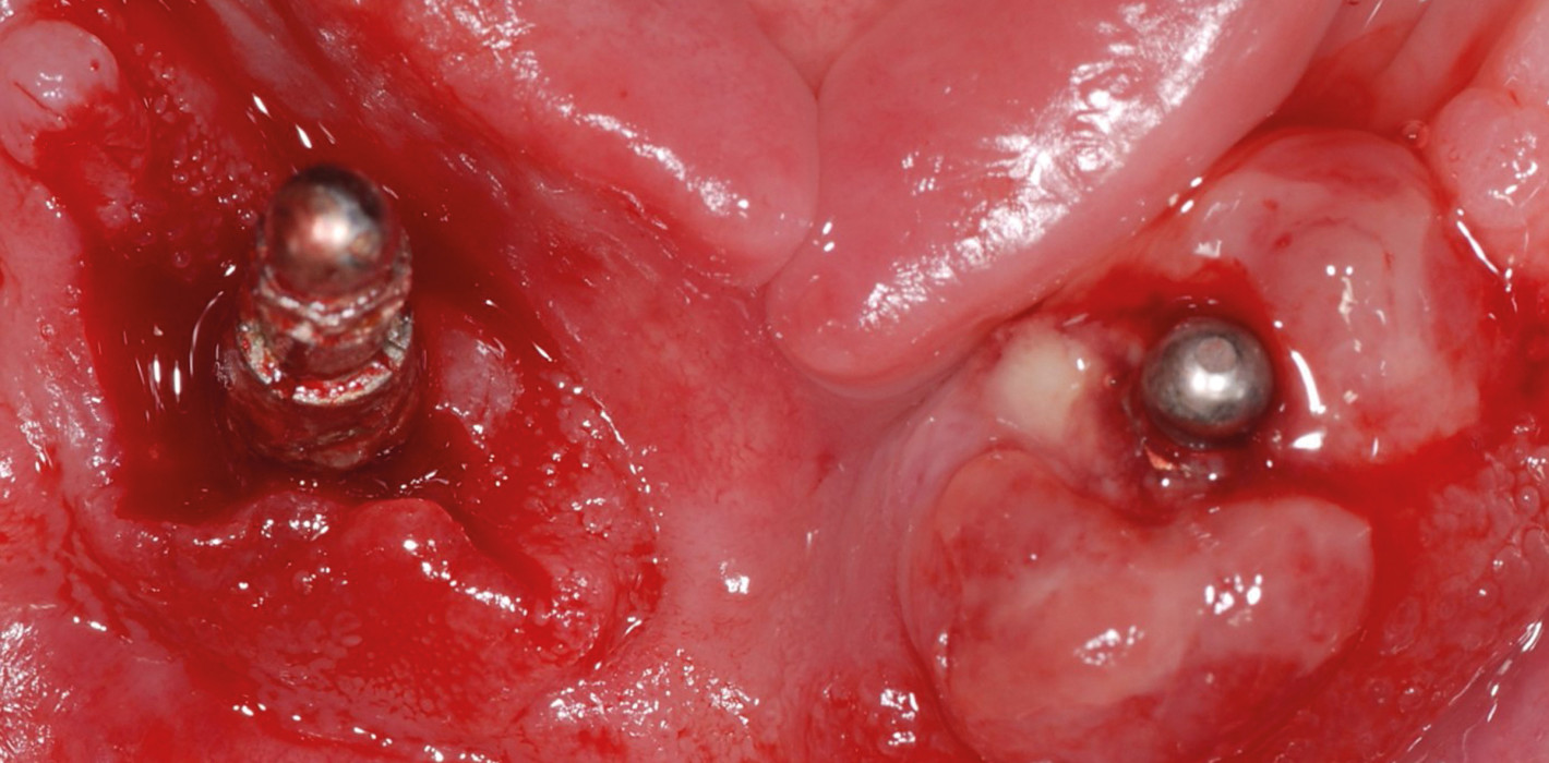 Rheuma – eine Kontraindikation für Implantate?