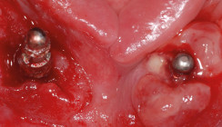 Rheuma – eine Kontraindikation für Implantate?