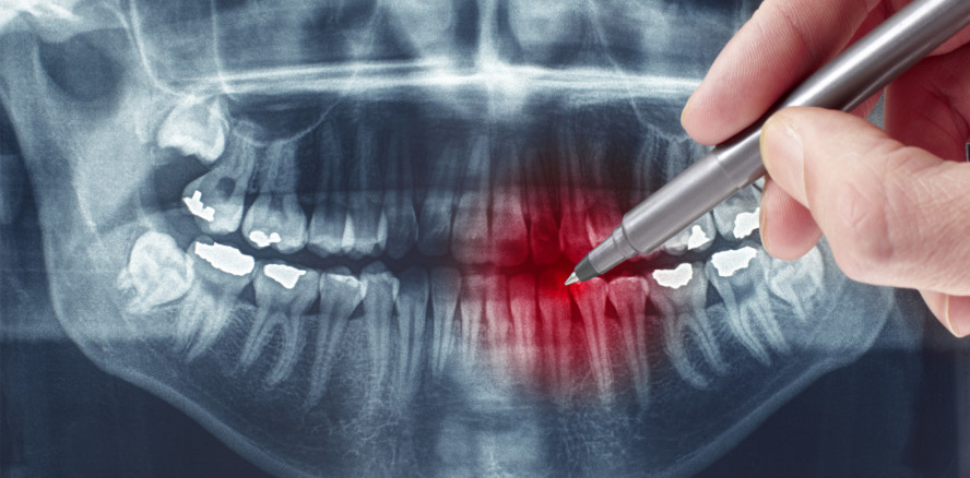 Widersprüchliche Röntgendiagnosen bei traumatisiertem Zahn
