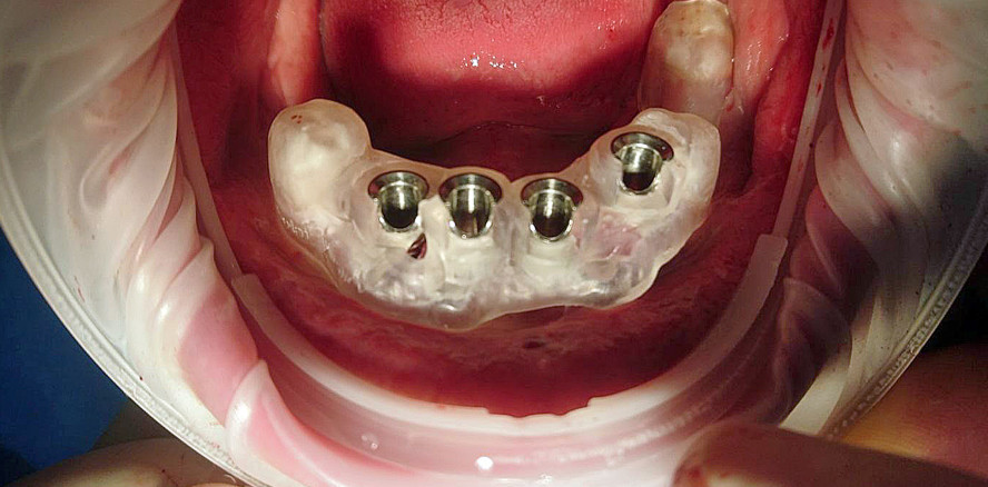 Sofortversorgung im Unterkiefer mit Stegkonstruktion