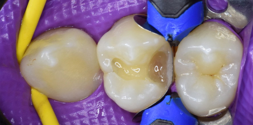 Seitenzahnfüllungen: Vereinfachung einer Routinebehandlung