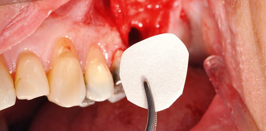 Einzeitige Sinusbodenelevation mit Augmentation
