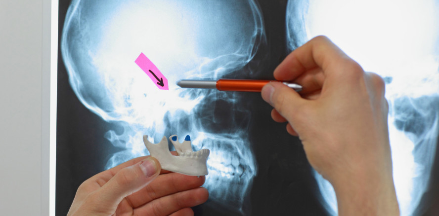 Odontogene Sinusitis maxillaris
