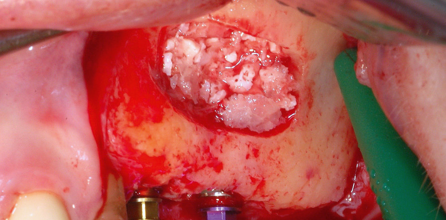 Externer Sinuslift mit simultaner Implantation