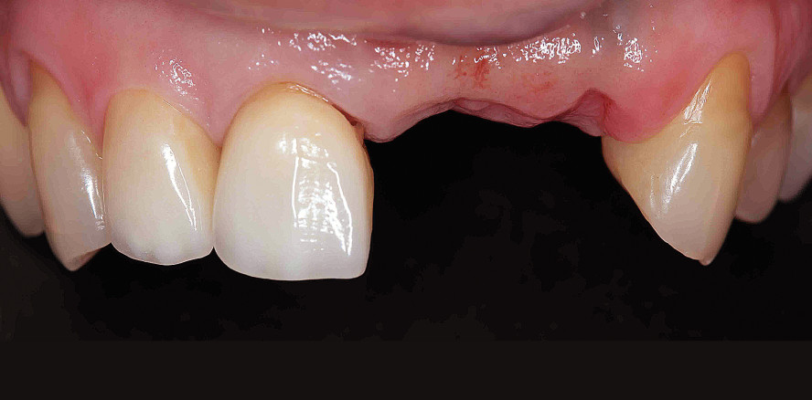 Sofortimplantation mithilfe der Socket-Shield-Technik