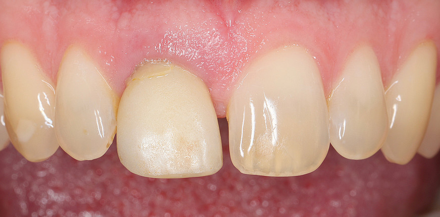 Sofortimplantation in der ästhetischen Zone
