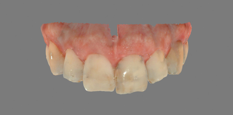 Sofortimplantation und Rekonstruktion: ein vollständig digitaler Workflow