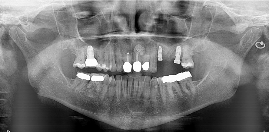 Sofortimplantation in der posterioren Maxilla
