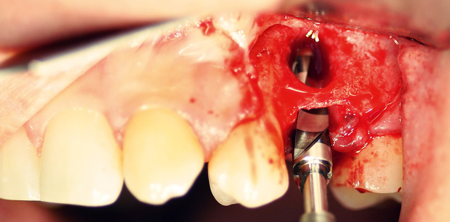 Sofortimplantation in beeinträchtigtem Knochen