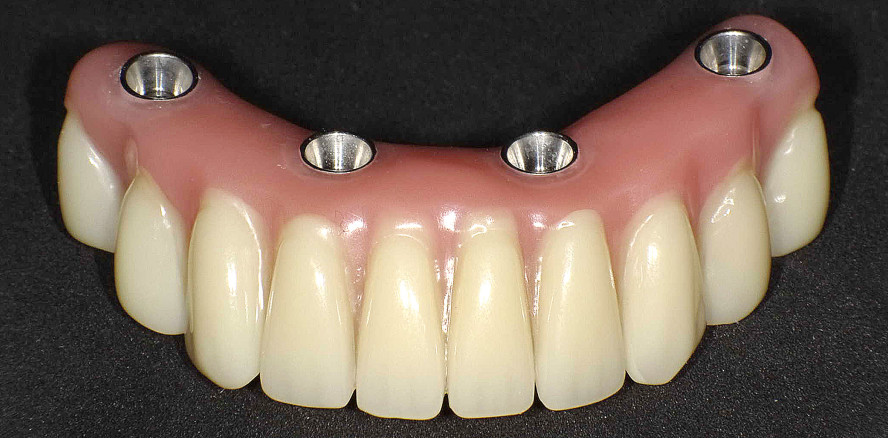 Bedingt herausnehmbare provisorische Sofortversorgung