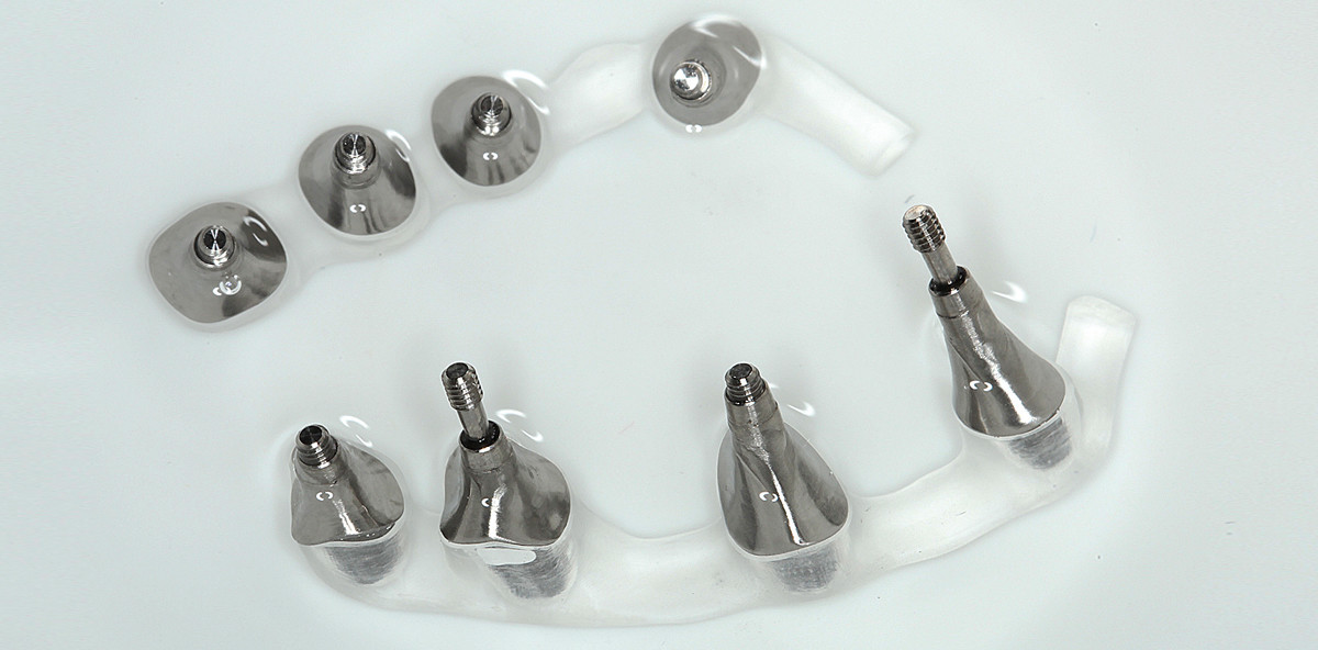 Stressfreie Sofortversorgung von Implantaten im Teamwork