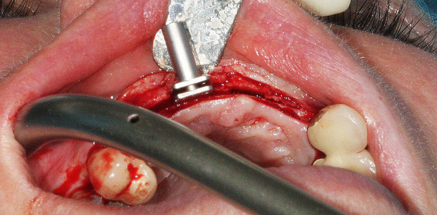 Bone Spreading – erfolgreicher Knochengewinn