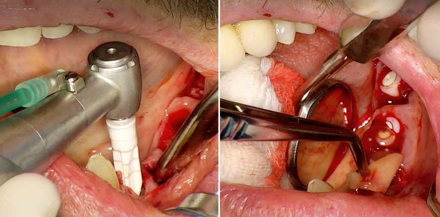 Effiziente Problemlösung durch Sofortimplantation