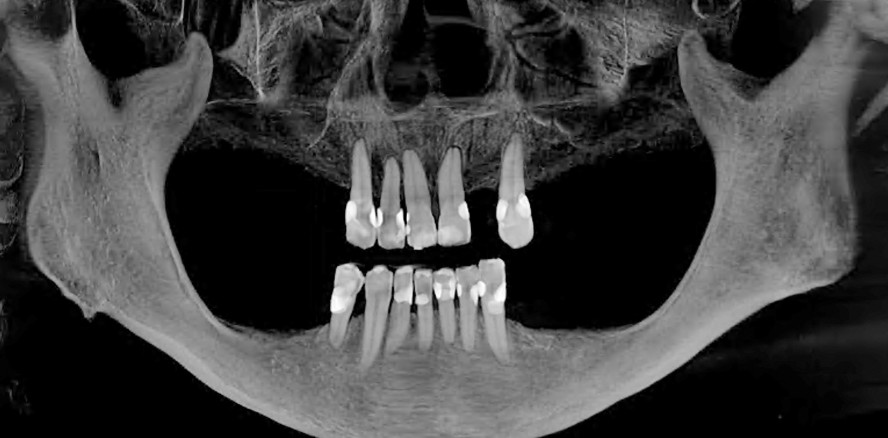 Biologische GBR und Keramikimplantate – Teil 2