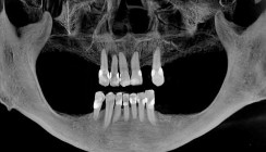 Biologische GBR und Keramikimplantate – Teil 2