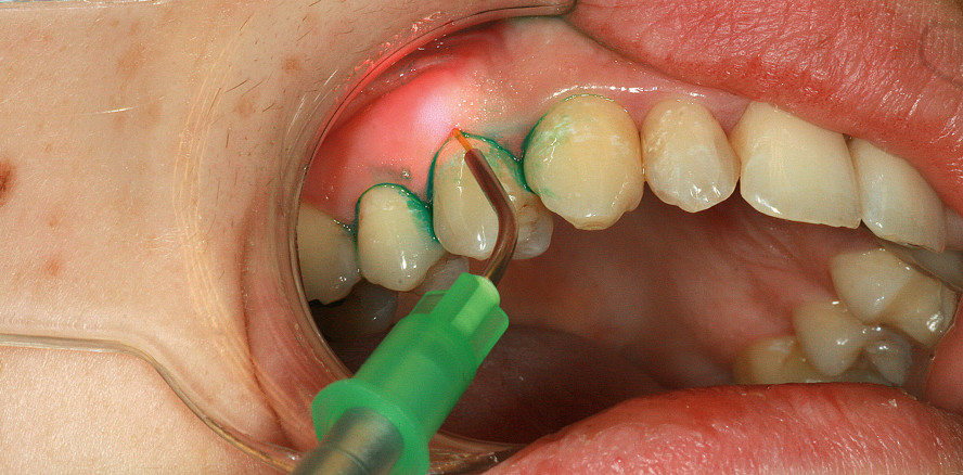Die Photodynamische und Photothermische Therapie