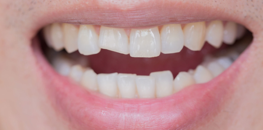 Komposit zur Reparatur nach Ermüdungsfrakturen