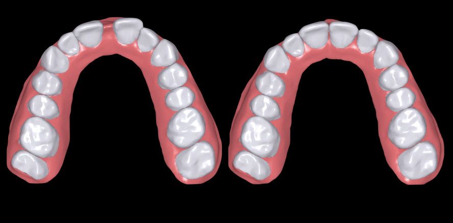 Patientenfreundliche Kieferorthopädie mit Clear Alignern