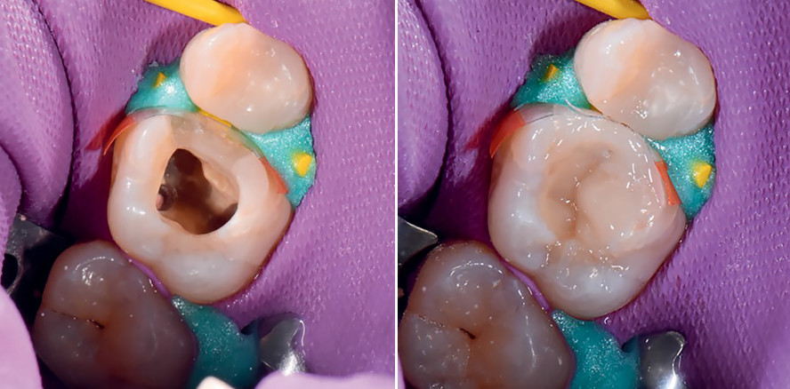 Versorgung eines endodontisch behandelten Zahnes mit Composite