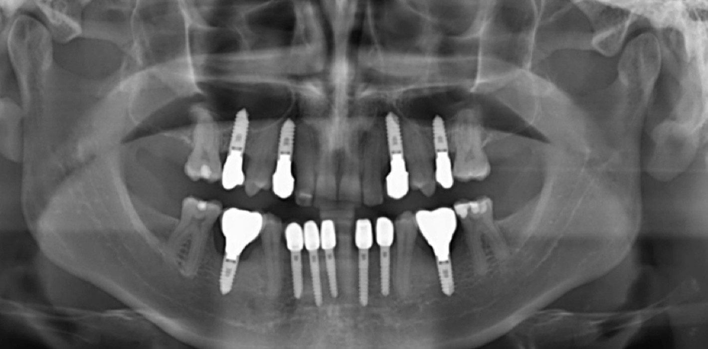 Implantatüberleben und -erfolg bei Patienten mit Hypodontie