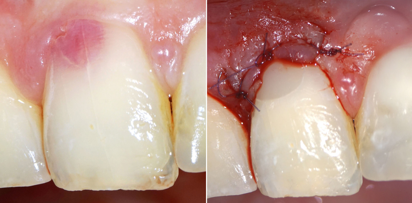 Therapie einer externen ­invasiven zervikalen Resorption