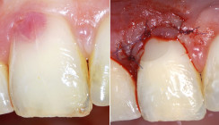 Therapie einer externen ­invasiven zervikalen Resorption