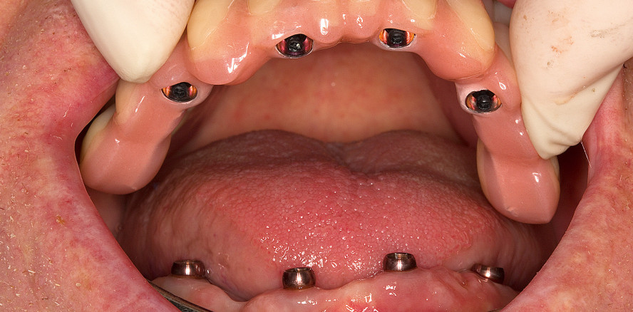 Festsitzende Totalprothetik ohne Zementieren und Verschrauben