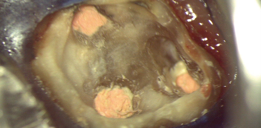 Revision – Die zweite Chance für den endodontisch behandelten Zahn