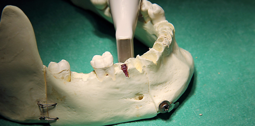 Sonografische Untersuchung bei Periimplantitis