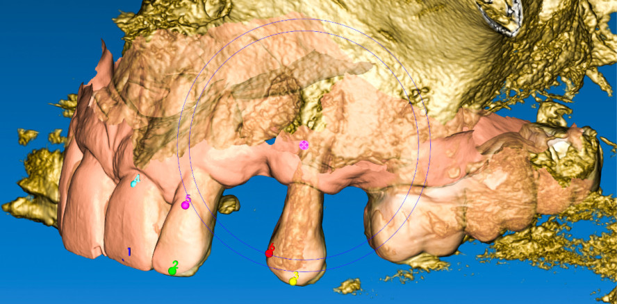 Stereolithografisch präfabrizierte chirurgische Schablonen und Brücken
