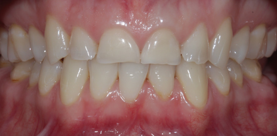 Oberkieferfrontversorgung mit 360-Grad-Veneers und Kompositaufbauten im SZB