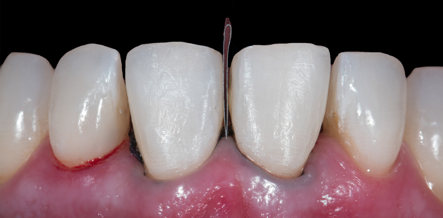 Die Grenzen einer minimalinvasiven Veneertherapie