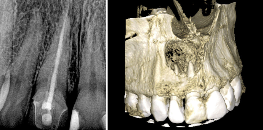 Apikale Läsion – behandeln oder nicht?