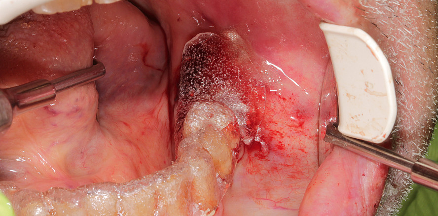 Die Verbandsplatte – Lösung für postoperative Nachblutungen