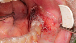 Die Verbandsplatte – Lösung für postoperative Nachblutungen