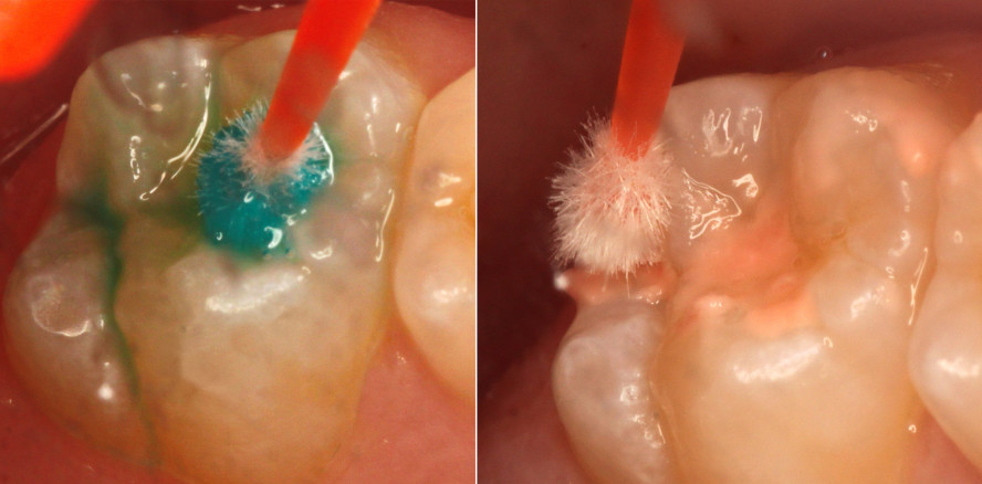 Glasionomerversiegler für vorausschauenden Schutz