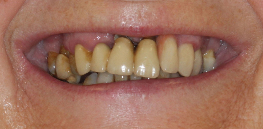 Versorgungsmethode im hochatrophen Oberkiefer