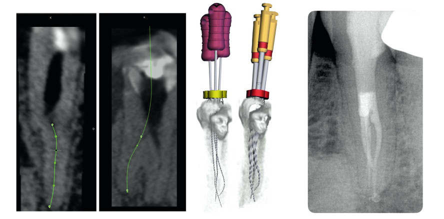 Virtuelle Vorplanung vereinfacht komplexe Fälle