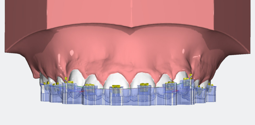 Virtuelle Bracketpositionierung – Zukunft für jede KFO-Praxis?