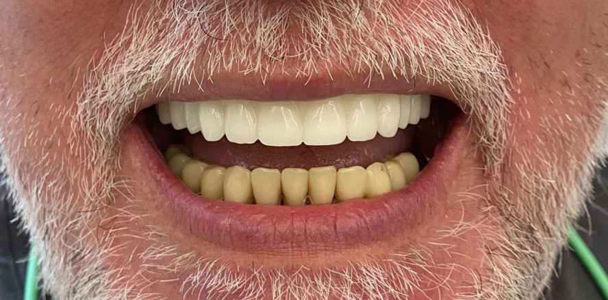 Von der Eierschale zur fertigen ­Teleskoparbeit