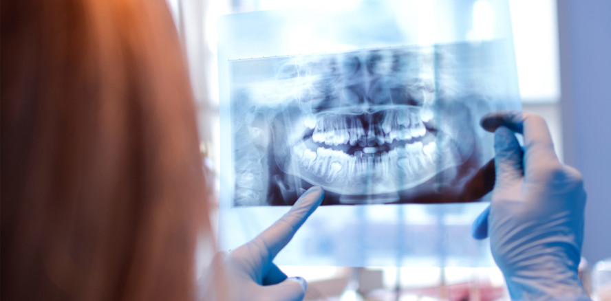 Wurzelkanalaufbereitung: Erhöhte Inzidenz für Microcracks?