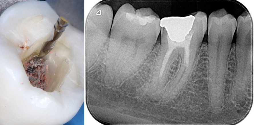 Innovative Systematik für die orthograde Revision von Wurzelkanälen