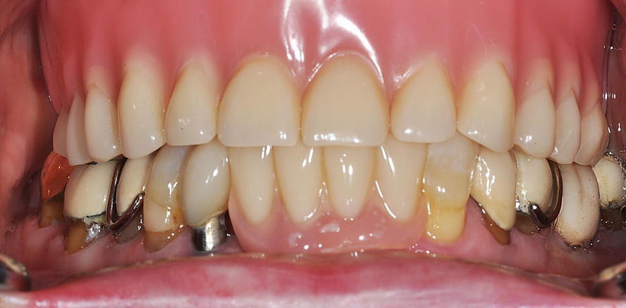 XY ungelöst: Probleme mit ­Attachments für implantatgetragene Deckprothesen